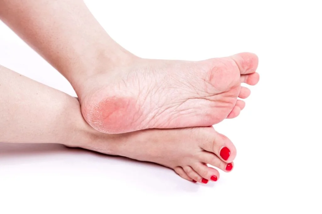 Close-up of a person's feet with one foot resting on top of the other and dry skin on the sole.