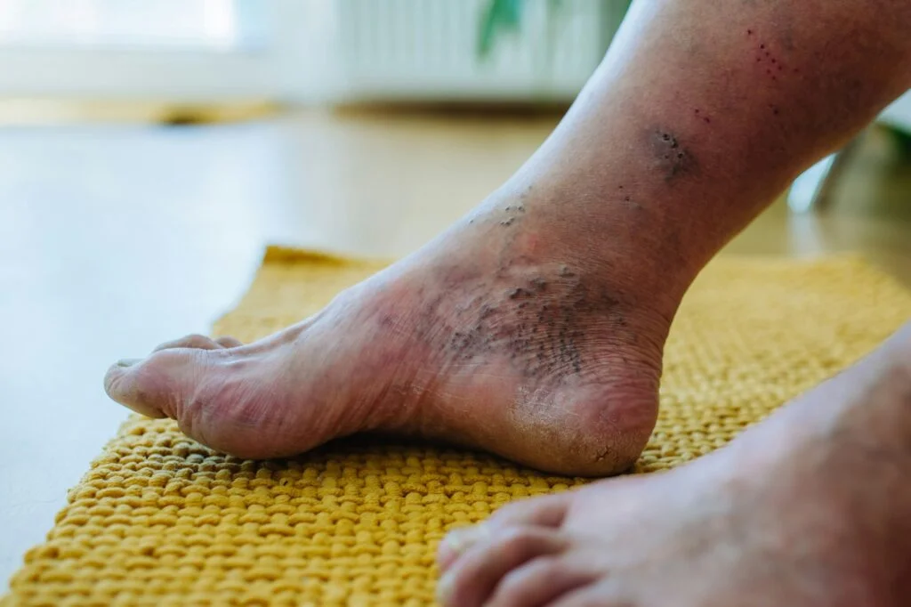 Close-up of swollen feet and ankles.
