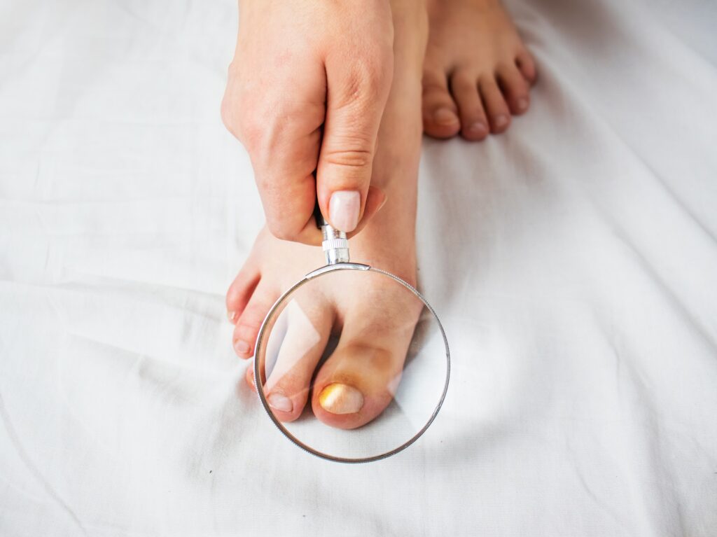 Person holding a magnifying glass over a toenail with a fungal infection.