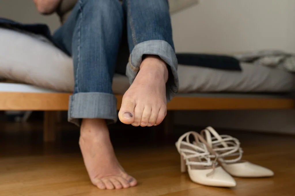 Person sitting on a bed with a bruised toenail.